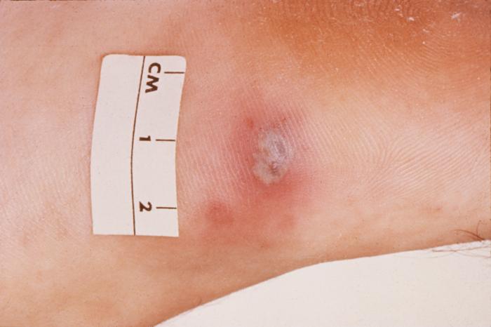 This is a photograph of a skin lesion on a patient diagnosed with gonorrhea. Gonorrhea, caused by Neisseria gonorrhoeae, if left untreated will enter the blood, thereby, spreading throughout the body. As is shown here, such full body dissemination may manifest itself as skin lesions throughout the body. Adapted from CDC