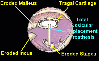 When the incus and arch of the stapes are eroded, or when the malleus, incus and arch of the stapes are absent, the ossicular chain is reconstructed with a total ossicular replacement prosthesis (TORP)[12].