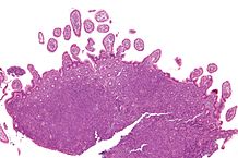 Micrograph of terminal ileum with mantle cell lymphoma (bottom of image). H&E stain.