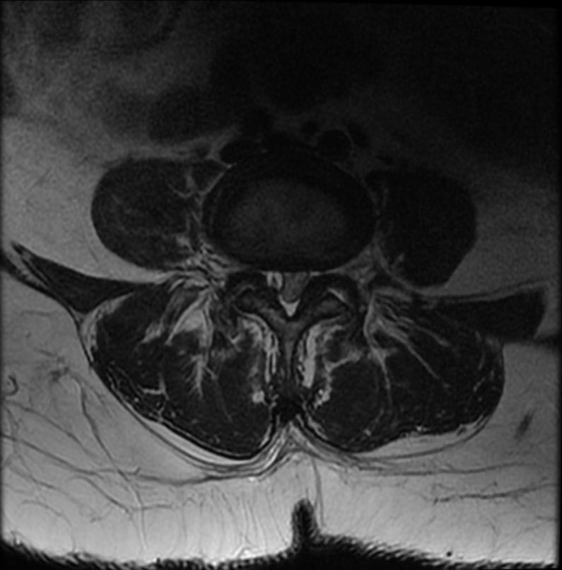 File:Intraspinal synovial cyst 002.jpg
