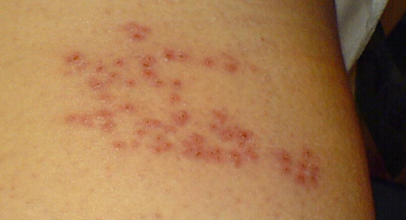 Herpes zoster blisters day 6, characteristic purple color.