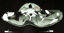 CT image of a 46-year-old patient with Hodgkin's lymphoma, image at neck height. On the left side of the patient's neck enlarged lymph nodes are visible (marked in red).