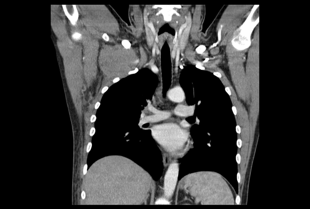 CT thorax after administrated contrast in arterial phase is showing large lesion in right subpectoral area encircling right subclavian artery. Artery is somewhat compressed but clearly without significant stenosis or occlusion.[3]