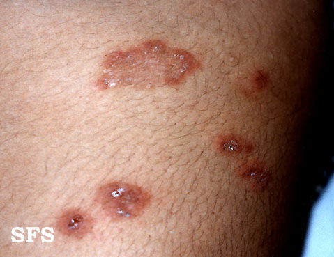 File:Dermatitis herpetiformis08.jpg