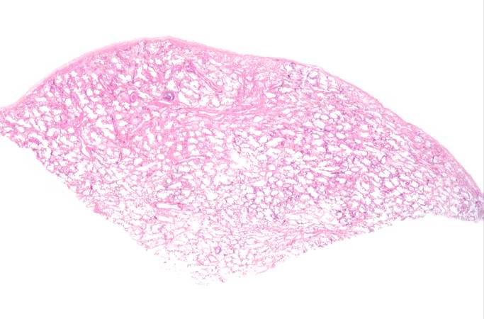 This low-power photomicrograph of the patient's lung illustrates large, open alveolar spaces. The pleural surface is the curved surface at the top.