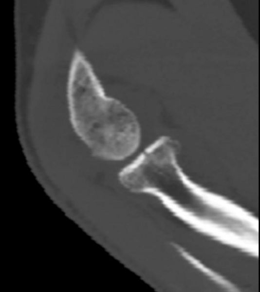 CT demonstrates radial head fracture and joint effusion Image courtesy of RadsWiki and copylefted