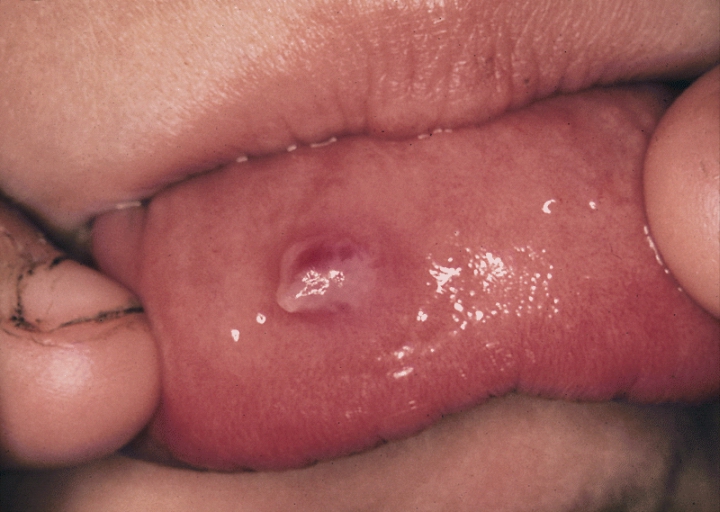 SALIVARY GLANDS: RUPTURED MUCOCELE. This mucocele of the lower lip has ruptured and collapsed due to trauma from lip biting.