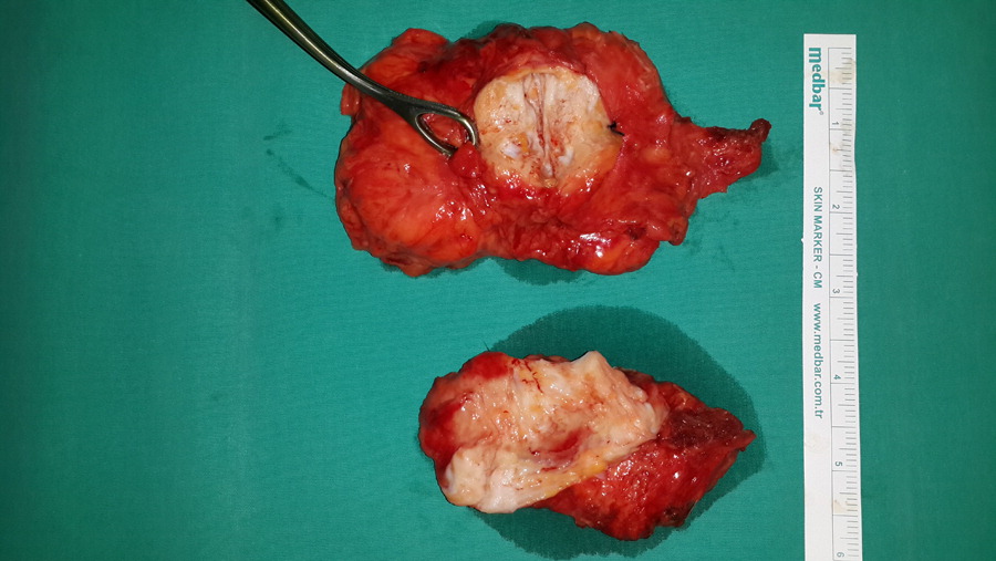 Bilateral Elastofibroma dorsi. Source:Science direct(under creative commons)[9]