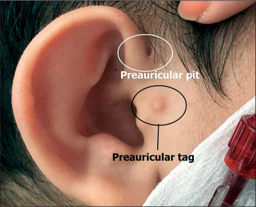 File:Preauricular pitting and skin tag in BOR syndrome.png