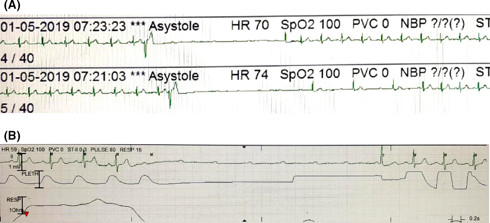 File:Single‐channel ECG recordings from ICU monitor. A, shows paroxysmal Phase 4 block triggered by a PVC. B, shows idiopathic paroxysmal AV block occurring without any obvious trigger.jpg