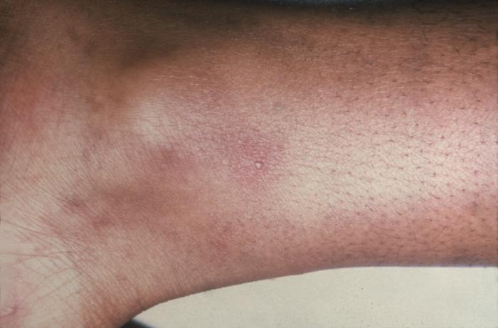 This patient presented with gonorrhea and a disseminated gonococcal skin infection about the ankle. Gonorrhea, caused by Neisseria gonorrhoeae, if left untreated will enter the blood, thereby, spreading throughout the body. As is shown here, such full body dissemination may manifest itself as skin lesions throughout the body. Adapted from CDC