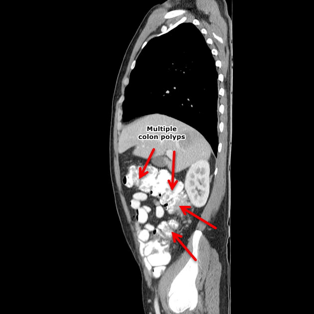 File:Sagittal CT - FAP.jpg