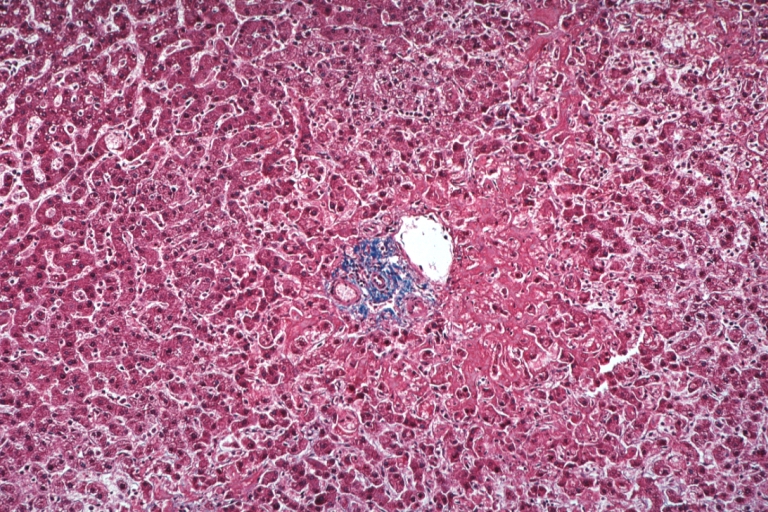 Lupus Erythematosus Hepatitis: Micro low mag trichrome stain periportal liver cell necrosis and sinus thrombosis with no inflammatory reaction cause unknown 19yo female with lupus erythematosus