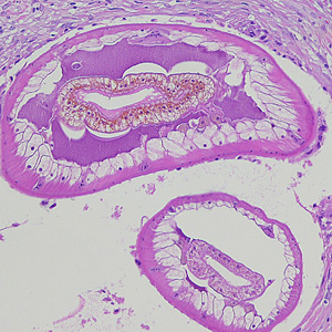 Cross-sections of larvae of D. renal in a subcutaneous nodule, stained with hematoxylin and eosin (H&E). Images courtesy of the Laboratory of Parasitology, National Public Health Research Center in Vilnius, Lithuania Adapted from CDC