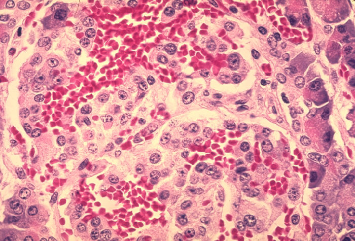 Histopathology of pancreas in fatal human plague Adapted from Public Health Image Library (PHIL), Centers for Disease Control and Prevention.[18]
