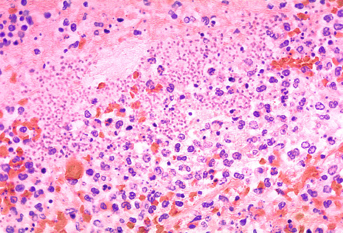 Histopathology of lung in fatal human plagueAdapted from Public Health Image Library (PHIL), Centers for Disease Control and Prevention.[15]