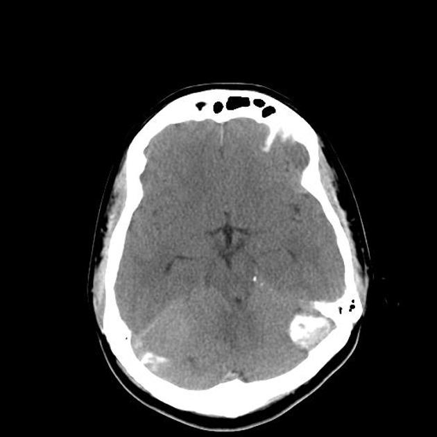 File:CT of neurofibromatosis type 2.jpg