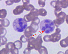 File:Hypersegmented neutrophil.png