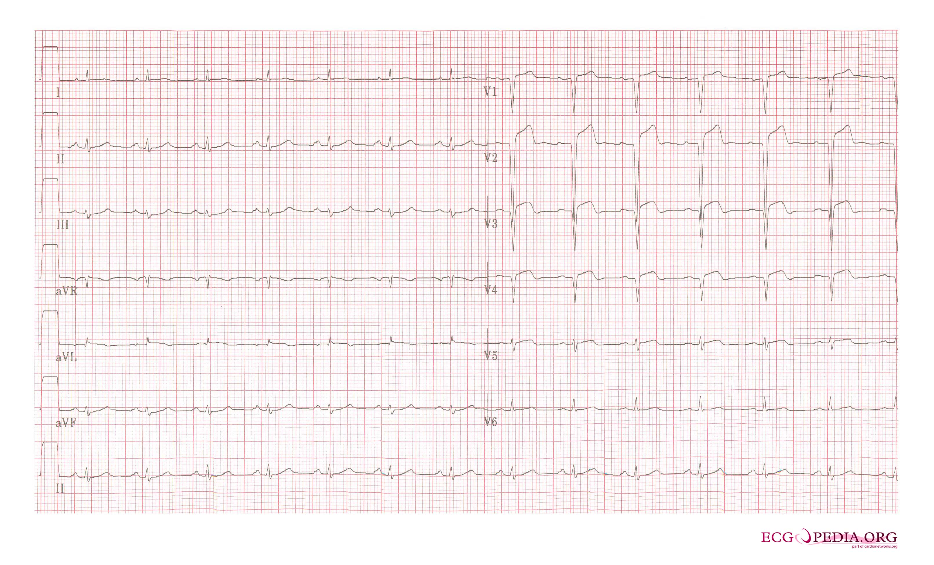 A 2 days old anterior infarction with Q waves in V1-V4 with persisting ST elevation, a sign of left ventricular aneurysm formation.