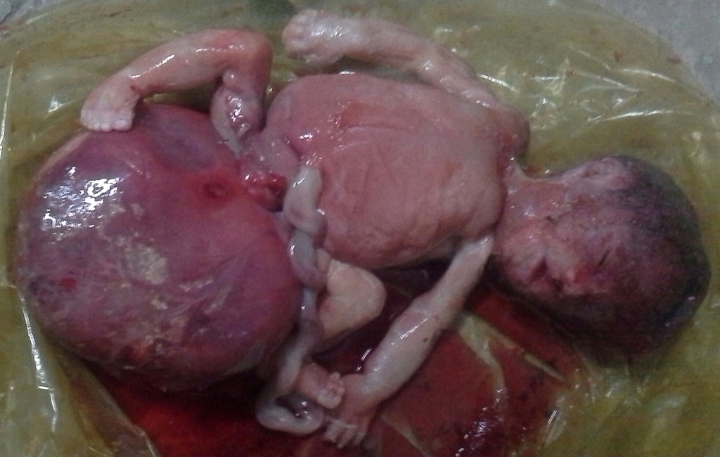 Gross Image of Sacrococcygeal teratoma [Case courtesy of Dr Saeed Soltany Hosn, Radiopaedia.org, rID: 33220]