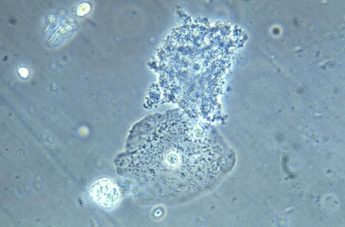 This photomicrograph of a vaginal smear specimen depicts two epithelial cells, a normal cell, and an epithelial cell with its exterior covered by bacteria giving the cell a roughened, stippled appearance known as a “clue cell”. Clue cells are epithelial cells that have had bacteria adhere to their surface, obscuring their borders, and imparting a stippled appearance. The presence of such clue cells is a sign that the patient has bacterial vaginosis. Adapted from CDC