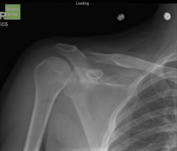 Anterior shoulder dislocation: Post-reduction