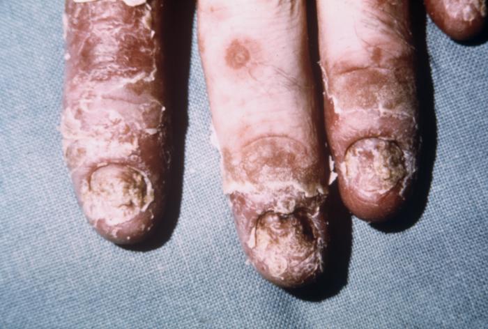Patient’s hands exhibited severe sloughing of the skin, which is a symptom of his diagnosed “Reiter’s syndrome”. From Public Health Image Library (PHIL). [1]