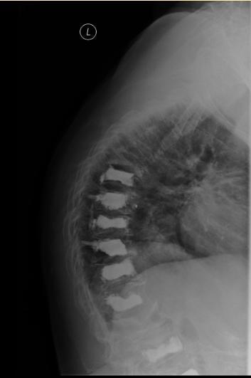 X ray spine showing collapsed vertebrae.