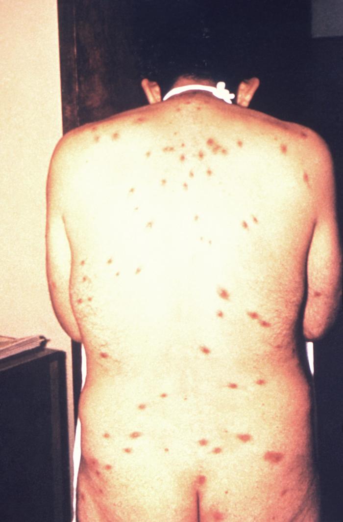 This was a posterior view of the back and buttocks of a male patient, in a clinical setting, who had presented with a pancorporeal maculopapular rash, which was initially thought to be a possible case of smallpox, but which later, was diagnosed as herpes simplex. Herpes simplex virus, otherwise known as Herpesvirus hominis is a member of a group of viruses including those which cause oral herpes, i.e., usually HSV-1, and genital herpes, i.e., usually HSV-2. The virus can become disseminated, as was the case here, usually involving patients who are immunocompromised such as in the case of AIDS, or undergoing chemotherapeutic treatment. Adapted from CDC