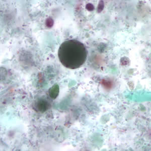 File:Bhominis cyst tric3.jpg