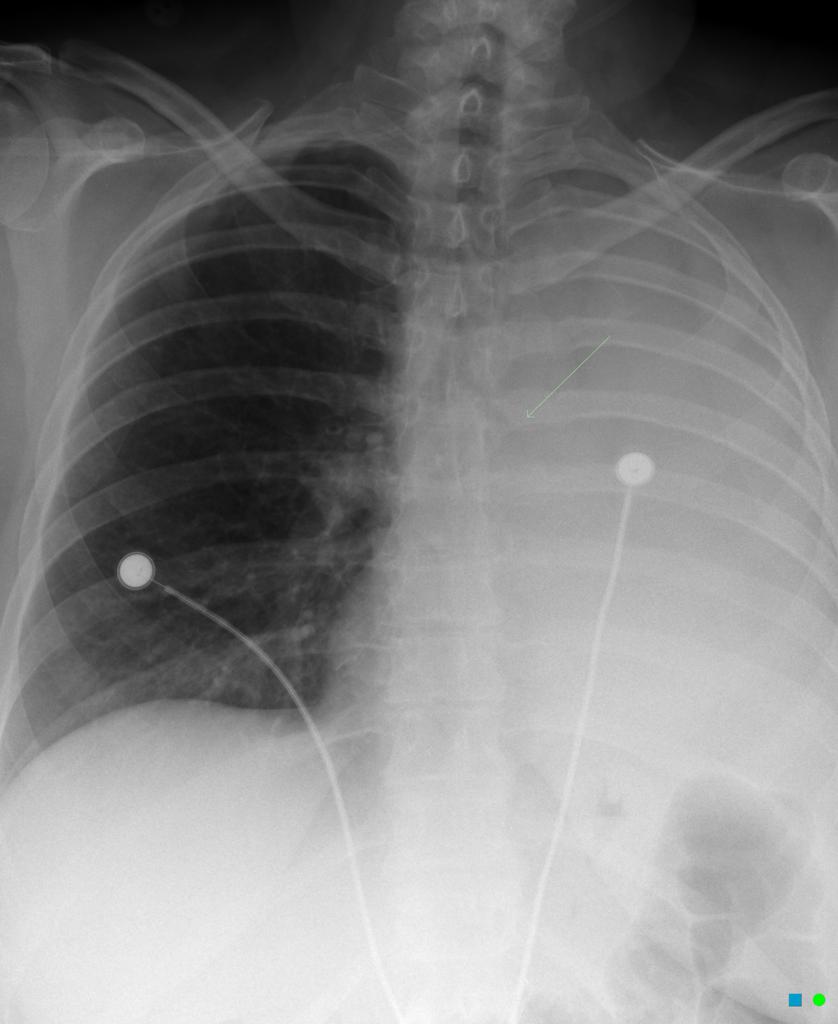 Bronchial cut off sign: abrupt truncation of a bronchus from obstruction via radiopedia.org Case courtesy of Dr Chris O'Donnell,[7]