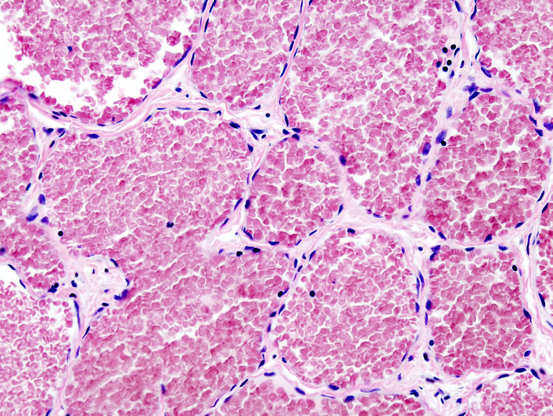 Histopathological image reprsenting a cavernous hemangioma of the liver. H&E stain.[3]