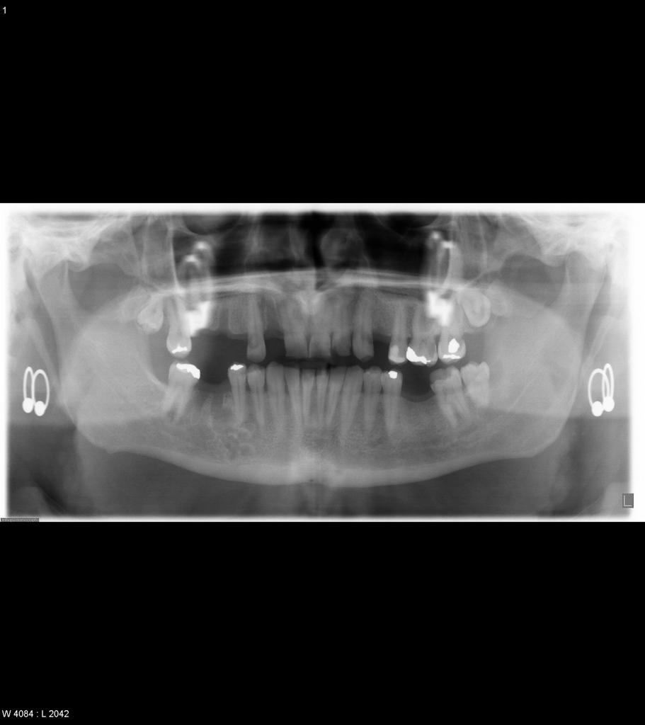 File:Frontal ameloblastoma x ray.jpg
