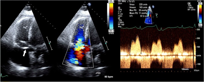 Tricuspid stenosis in echocardiography