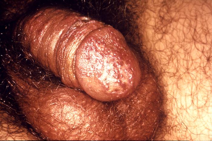 This male presented with primary vesiculopapular herpes genitalis lesions on his glans penis, and penile shaft. When signs of herpes genitalis do occur, they typically appear as one or more blisters on or around the genitals or rectum. The blisters break, leaving tender ulcers (sores) that may take two to four weeks to heal the first time they occur.