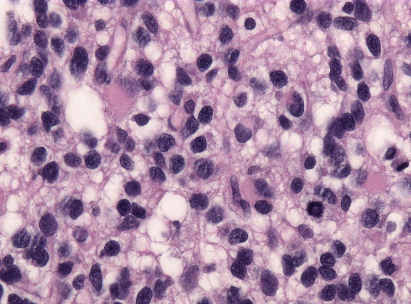 File:Anaplastic oligodendroglioma minigemistocytes.jpg