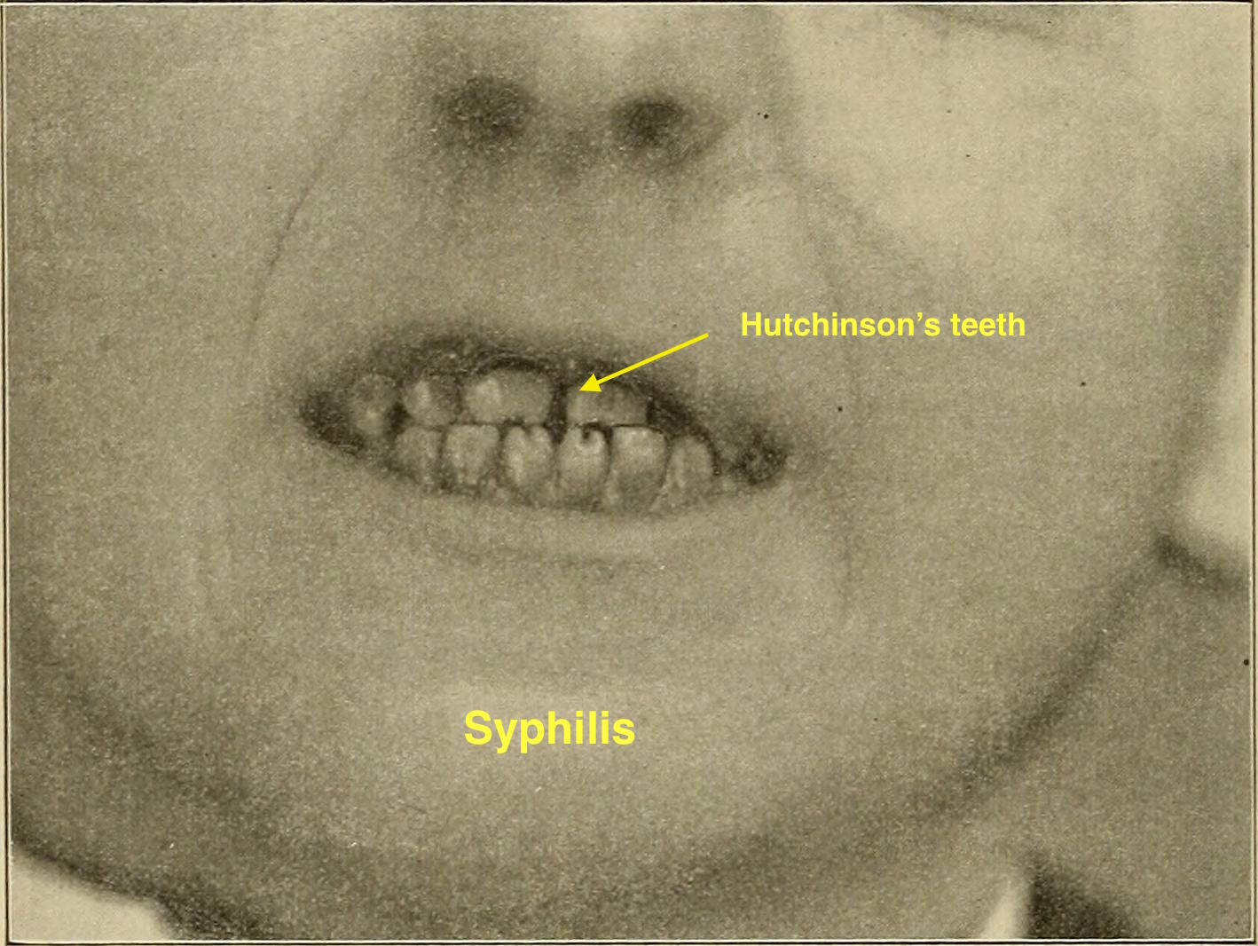 File:Syphilis orala.jpg