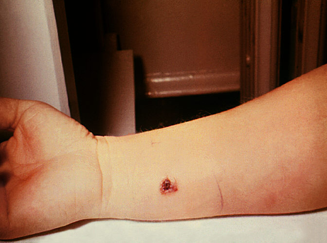 "Anthrax, skin of right forearm, 7th day.”Adapted from Public Health Image Library (PHIL), Centers for Disease Control and Prevention.[3]