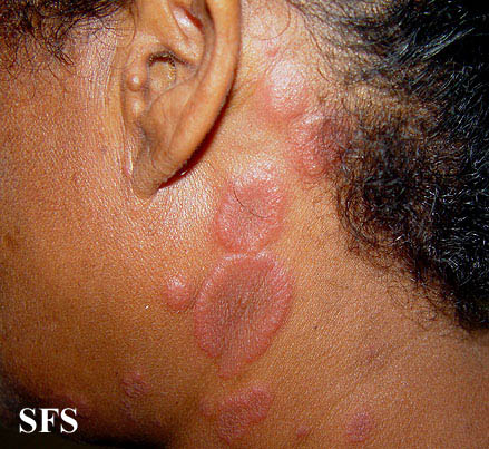 .:Erythema multiforme Adapted from Dermatology Atlas.[1]