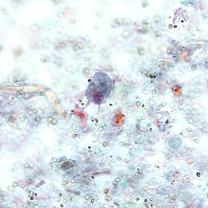 Trophozoite of R. intestinalis in a stool specimen, stained with trichrome. Adapted from CDC