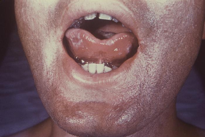 This image depicts the tongue of a patient, who’d presented with what was described as a number of syphilitic mucous patches, due to what was diagnosed as secondary syphilis. The secondary stage of syphilis is characterized by the manifestation of a skin rash and mucous membrane lesions. This stage typically starts with the development of a rash on one or more areas of the body. The rash usually does not cause itching. Rashes associated with secondary syphilis can appear as the chancre is healing or several weeks after the chancre has healed. The characteristic rash of secondary syphilis may appear as rough, red, or reddish brown spots both on the palms of the hands and the bottoms of the feet. However, rashes with a different appearance may occur on other parts of the body, sometimes resembling rashes caused by other diseases. Sometimes rashes associated with secondary syphilis are so faint that they are not noticed. In addition to rashes, symptoms of secondary syphilis may include fever, swollen lymph glands, sore throat, patchy hair loss, headaches, weight loss, muscle aches, and fatigue. The signs and symptoms of secondary syphilis will resolve with or without treatment, but without treatment, the infection will progress to the latent and possibly late stages of disease. Adapted from CDC