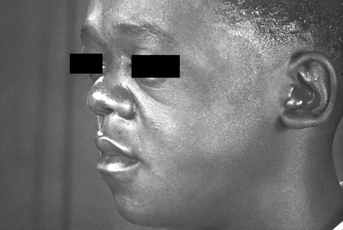 This 16 year old patient presented with a "saddle nose" deformity due to a congenital syphilitic condition. See PHIL 17626, for a color version of this image. The presence of the Treponema pallidum bacterium detrimentally affects the normal cytoarchitectural development of the soft, boney precursor tissues such as cartilage, giving rise to boney malformations like this “saddle nose” deformity. Adapted from CDC