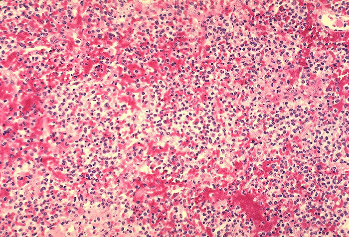 Histopathology of lung in fatal human plague. Area of marked fibrinopurulent pneumonia Adapted from Public Health Image Library (PHIL), Centers for Disease Control and Prevention.[15]