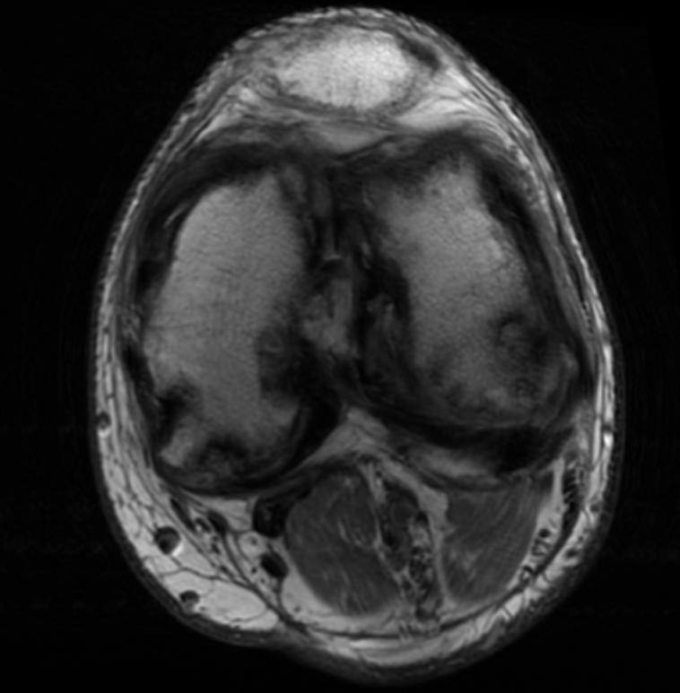 Knee MRI in a patient with Hemophilia