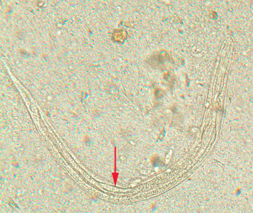 Rhabditiform larva of S. stercoralis in an unstained wet mount of stool. Notice the short buccal canal and the genital primordium (red arrow). Adapted from CDC