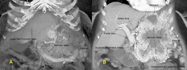 (A)3-D CT coronal reconstruction showing the pancreatic VIPoma, a large peri-tumoral varix, and gastric varices. (B) 3-D CT coronal reconstruction depicting relation of pancreatic VIPoma to adjacent vascular structures and stomach. Note presence of varices as well as invasion of tumor into the fourth portion of the duodenum.[2]