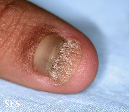 Onychomycosis. Adapted from Dermatology Atlas.[6]