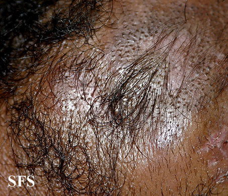 Syringolymphoid hyperplasia with alopecia. Adapted from Dermatology Atlas.[1]