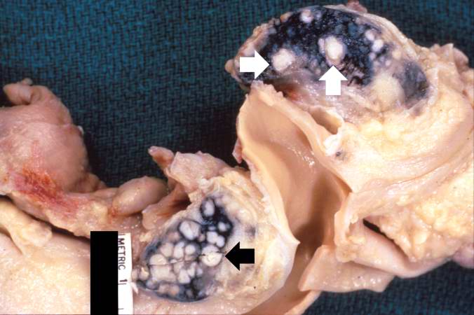 This gross photograph shows hilar lymph nodes from another patient with disseminated tuberculosis. The white, cheesy-appearing nodules (arrows) in the lymph nodes give rise to the descriptive terminology of caseous necrosis. The black pigment in the lymph nodes is anthracotic pigment that has drained from the lungs.