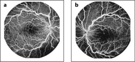 File:Fluorescein angiography.png